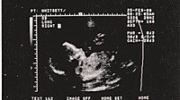 1988-02-25 Whitsett ultrasound likely Avery.jpg